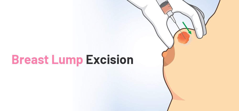 Breast Lump Excision